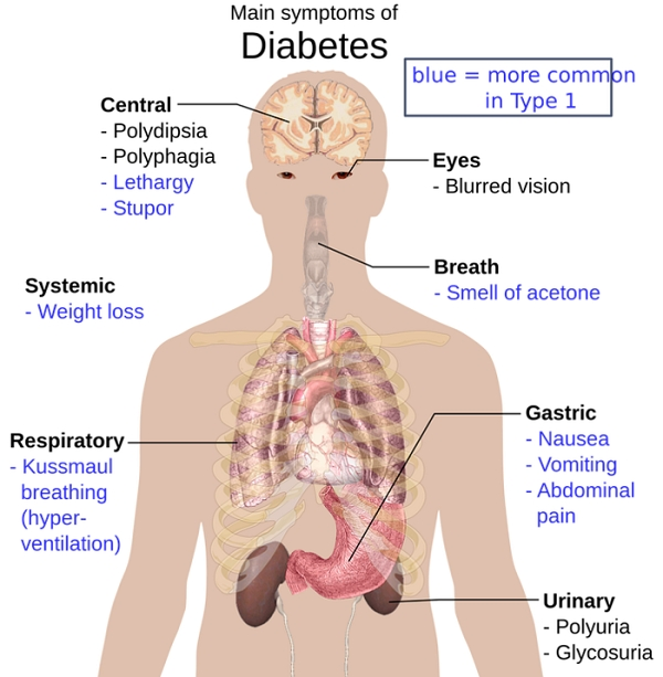 ▲  당뇨병이 생기면 10년 내에 약 30%가 당뇨망막증이 오고, 60%가 발 질환이 생겨 심한 경우 발을 절단해야 한다. 전체 심장질환의 60%, 신장질환의 30%가 당뇨병으로 인한 합병증이다.